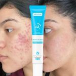 MOOYAM Salicylic Acid Acne Removal Gel - img 2