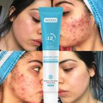 MOOYAM Salicylic Acid Acne Removal Gel - img 1